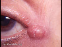 sebaceous cyst at outer canthal region