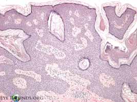 Seborrheic keratosis