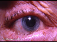 senile, entropion / involutional entropion