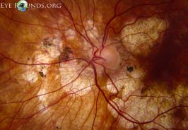 Serpiginous choroidopathy