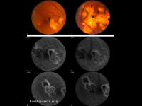 Serpiginous