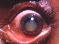 Morgagnian hypermature cataract
