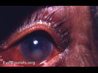 Morgagnian cataract