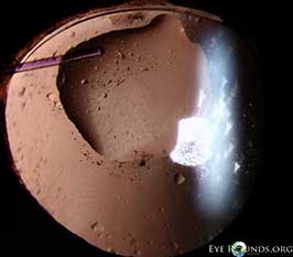 Silicone oil droplet on intraocular lens (IOL)