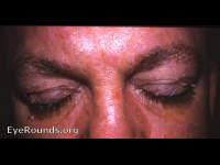 skin tags of the eyelids