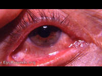 slitting of inferior canaliculus