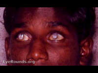 smallpox blindness - destroyed corneas-result of hypopyon ulcer of both eyes