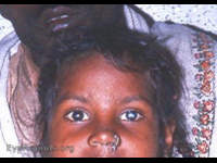 smallpox: central leukomatous corneal scar OU