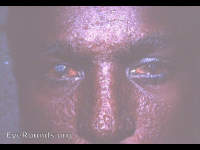 Smallpox: extensively pocked face and blind from bilateral hypopyon ulcer - 1964