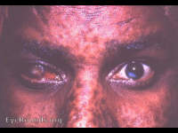 heavily vascularized, large adherent leukoma right eye and smaller off-center adherent leukoma, left eye