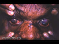 smallpox: marked staphyloma of cornea OU 1962