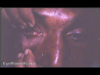 smallpox with symblepharon to cornea and bulbar conjunctiva