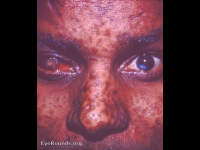 Smallpox - vascularized leukoma right eye and adherent leukoma, left eye