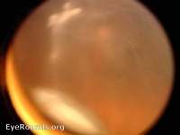 pars planitis
