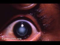 Congenital cataract, left eye- 23yr old female with similar lesion, right eye
