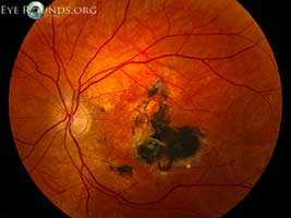 Sorsby Macular dystrophy