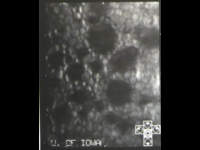Fuch's Endothelial Corneal Dystrophy