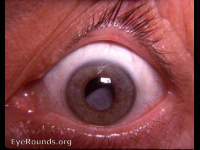 spontaneously subluxated cataract with a history of recurrent anterior uveitis