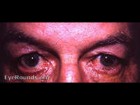 spastic entropion - left lower lid