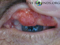 Squamous papilloma of the upper lid