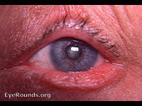 ectropion of lower lid due to squamous cell carcinoma of tarsal conjunctiva