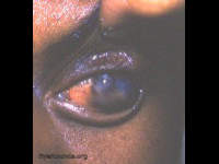 staphyloma, left eye