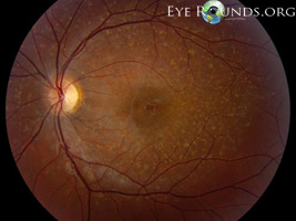 Stargardt's disease