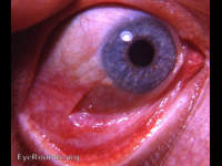 Stevens-Johnson Syndrome