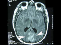 bilateral occipital infarcts (stroke)