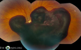 Leukemic retinopathy, Sub-inner limiting membrane hemorrhage