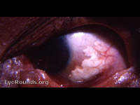 residuum of subconjunctivally injected long-acting steroid preparation