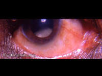 subluxated cataract - spontaneous