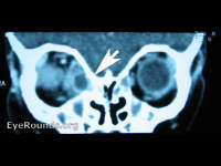 subperiosteal abscess