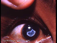 superficial burn of the cornea