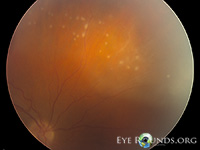 Syphillitic punctate inner retinitis