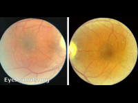 talc retinopathy