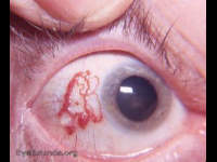 lymphangiectasia hemorrhagica conjunctivae