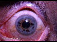 tigroid iris: with a number of dark-brown nevi