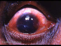 trachoma, typical pannus