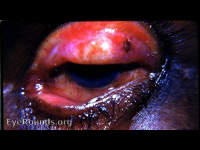 Trachoma, extensive