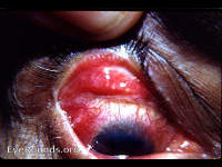 Trachoma