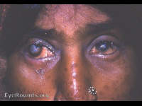 smallpox and trachoma: leukoma of each cornea trichiasis, and facial pock marks.