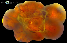 Traction retinal detachment secondary to proliferative diabetic retinopathy