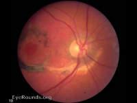 choroidal rupture