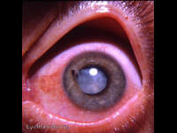 intumescent traumatic cataract with ectropion uveae