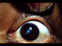 traumatic aftercataract following a perforating injury of cornea