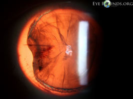 Traumatic aniridia and cataract