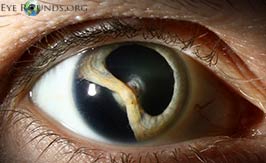 Traumatic cataract with iridodialysis and lens coloboma