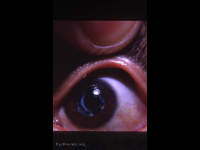 posterior lens capsule remnants following needling of traumatic cataract, left eye