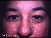 Pringle's Disease (adenoma sebaceum) in patient with tuberose sclerosis (tuberous sclerosis) (Bourneville's Disease)
